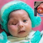 Al-Shifa Doctors Successfully Operate on Infant with Rare Eye Tumour